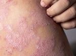 finfeng_Clonaderm Cream
