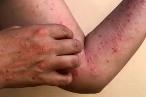 Waspada Darurat Kesehatan Global, Kasus Mpox Melonjak