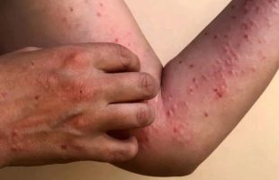 Waspada Darurat Kesehatan Global, Kasus Mpox Melonjak