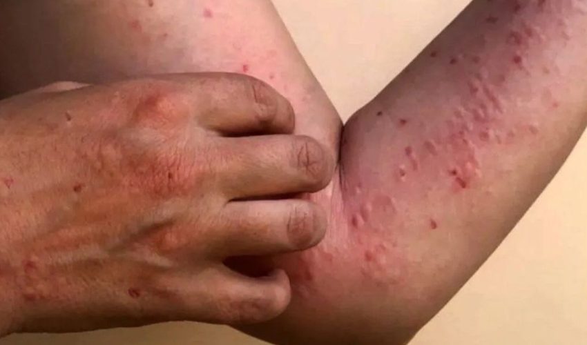 Waspada Darurat Kesehatan Global, Kasus Mpox Melonjak